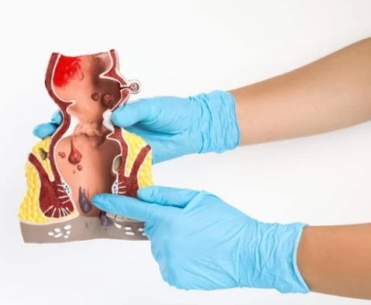 Bệnh trĩ do đâu mà có?